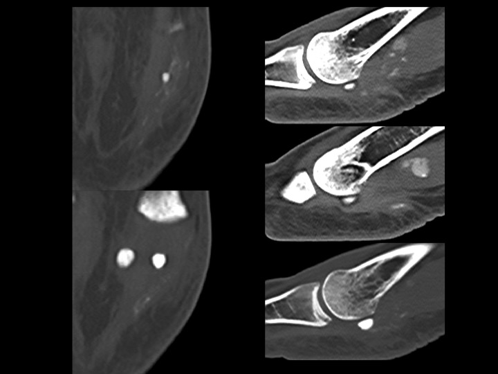 Figure 5 for case calcium hydroxyapatite crystal deposition disease ( RID3594 )